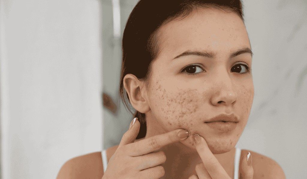 Acne Treatment in Bangalore