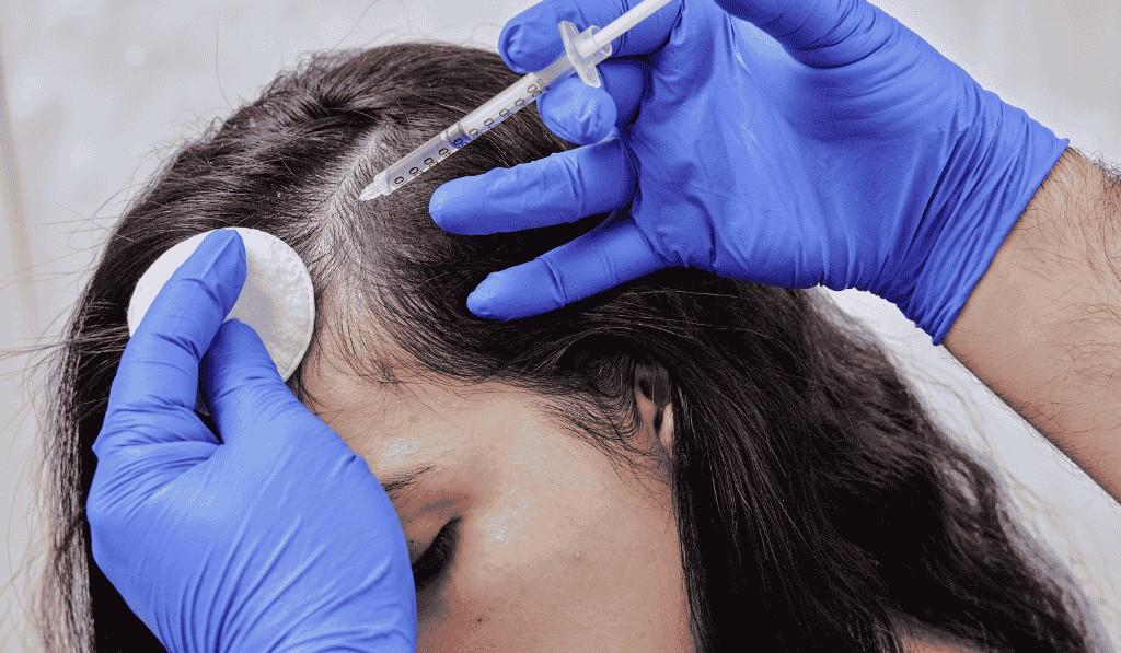 Hair Loss Treatment in Bangalore