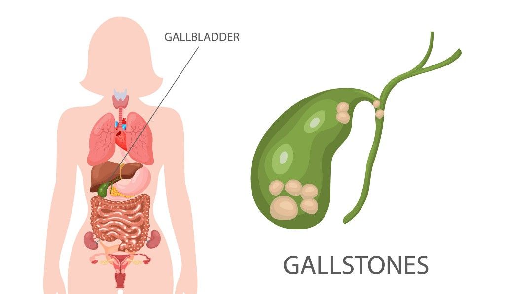 Gallbladder Stone Symptoms That Need Quick Attention
